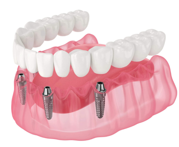 Teeth Replacement
